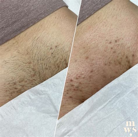 hairy brazilian|Brazilian Wax Before and After – WAXINGPROS.COM.